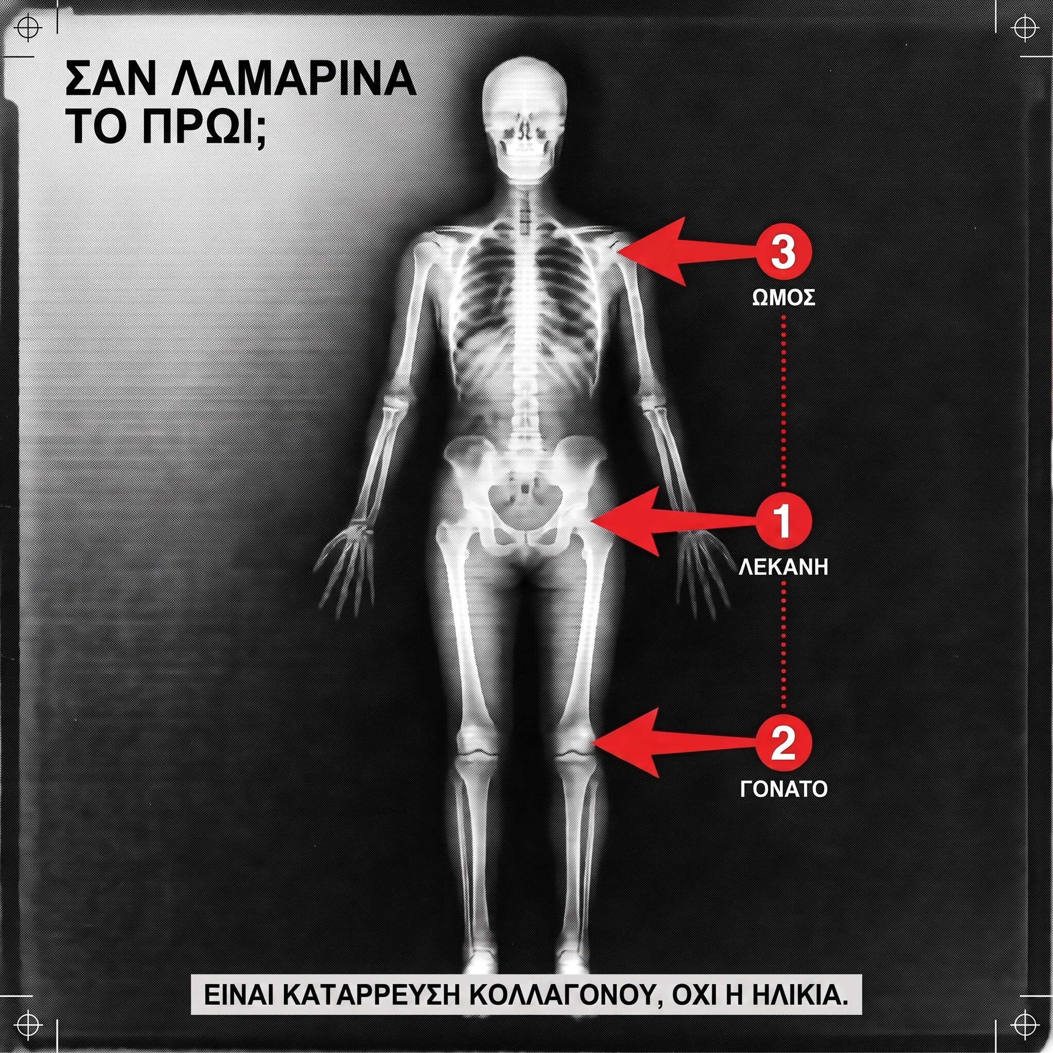 Καταρράκτης κολλαγόνου, ισχίο, γόνατο και ώμος σημειωμένα με τρία κόκκινα βέλη σε ακτινογραφία